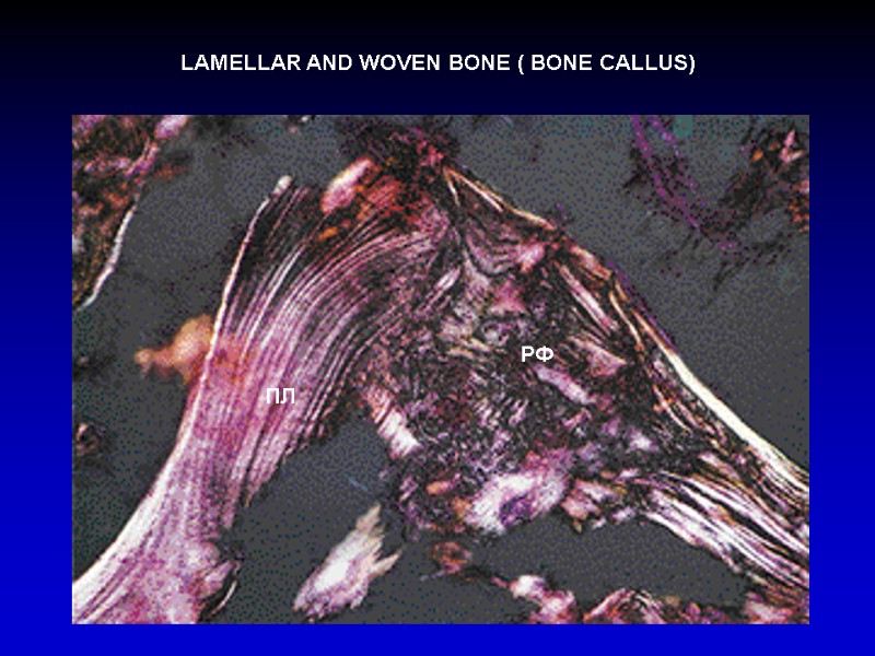 LAMELLAR AND WOVEN BONE ( BONE CALLUS) ПЛ РФ